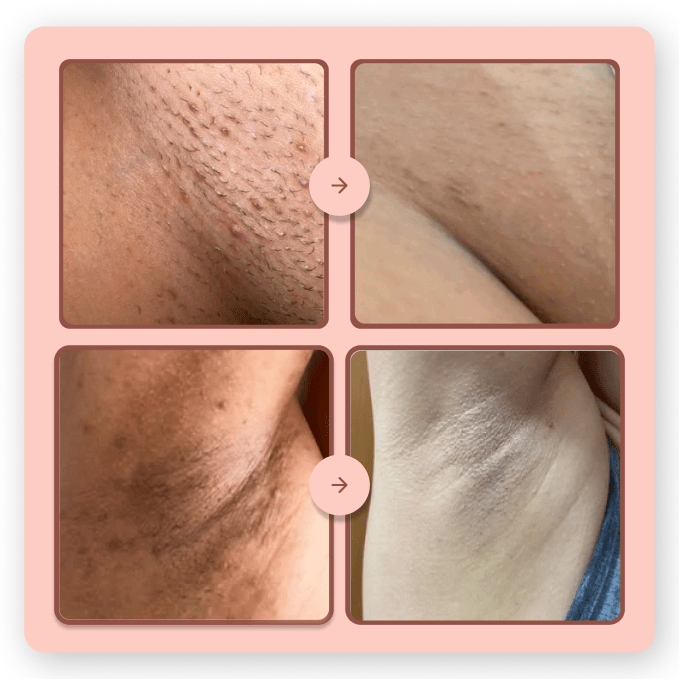 Depilador Anti Foliculite Nanda Intimus - Nanda Intimus