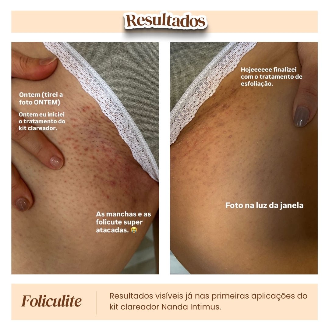 Kit Clareador de Manchas - Nanda Intimus