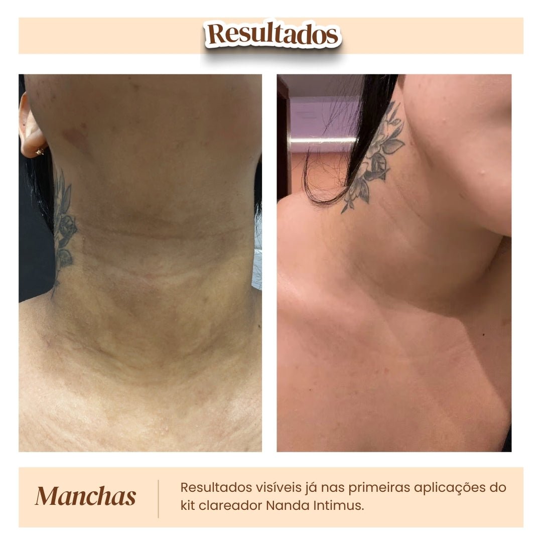 Kit Clareador de Manchas - Nanda Intimus