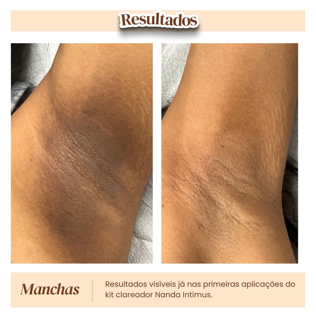 Kit Clareador de Manchas - Nanda Intimus