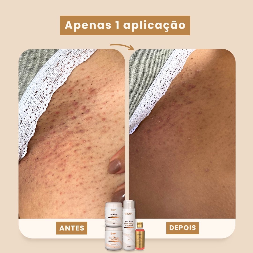 Kit Clareador Nanda Intimus + Depilador Anti Foliculite - Tratamento Definitivo - Nanda Intimus