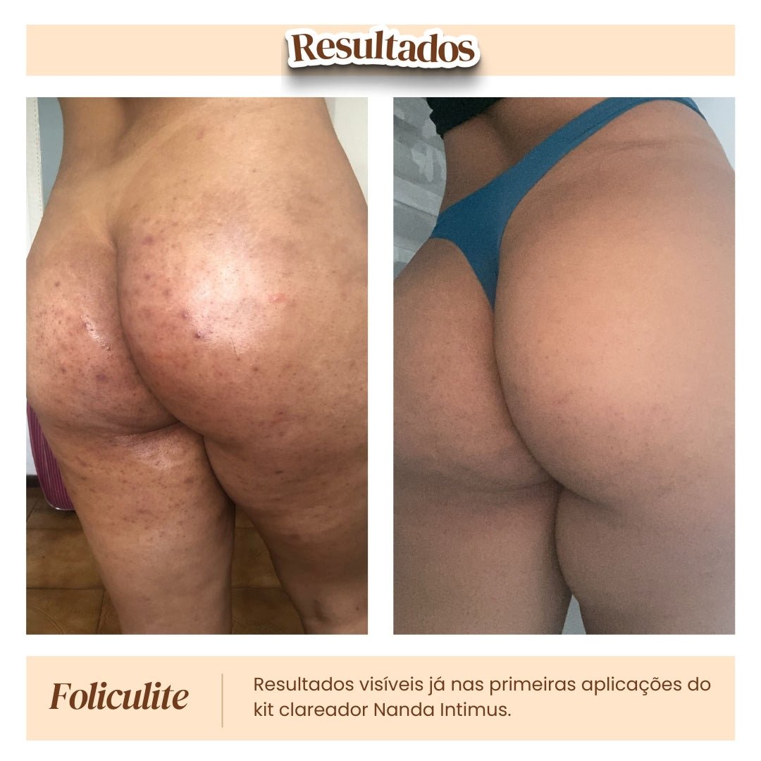 Kit Clareador de Manchas - Nanda Intimus